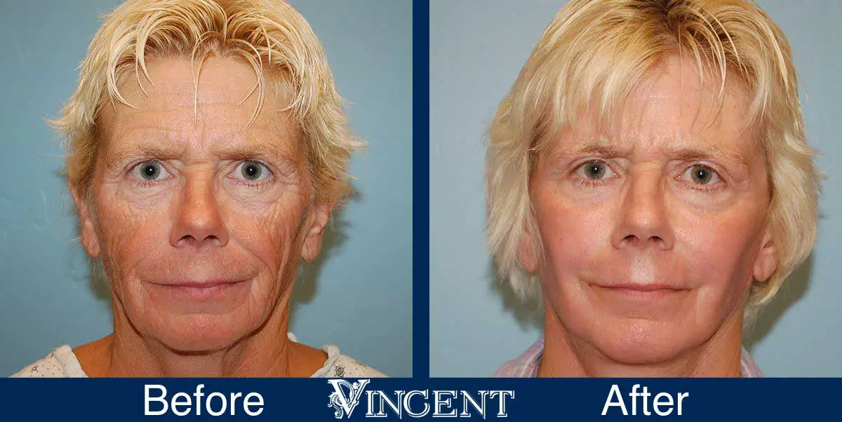 1029_SwiftLift_CO2_full_face_fat_grafting_Drake_Vincent_Facelift_Utah_frontview