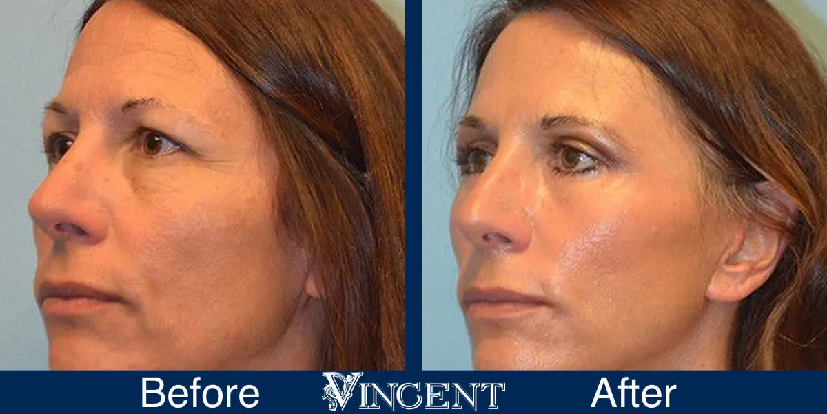 Blepharoplasty-before-and-after-utah-2602-Front-Left