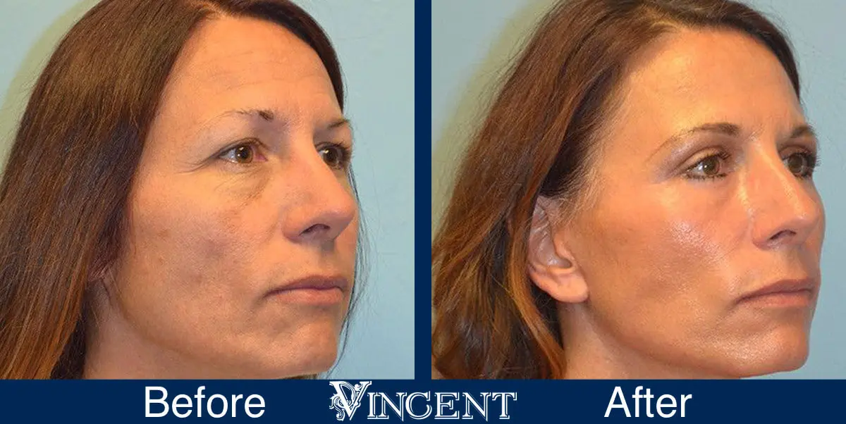 Blepharoplasty-before-and-after-utah-2602-Front-Right