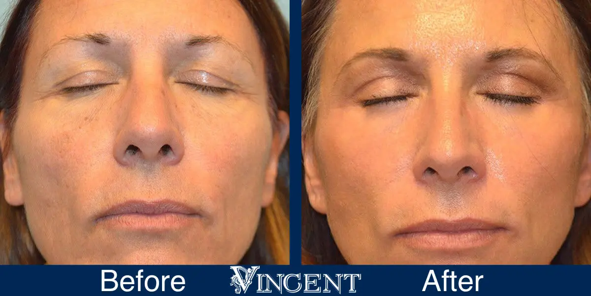 Blepharoplasty-before-and-after-utah-2602-Front-closed