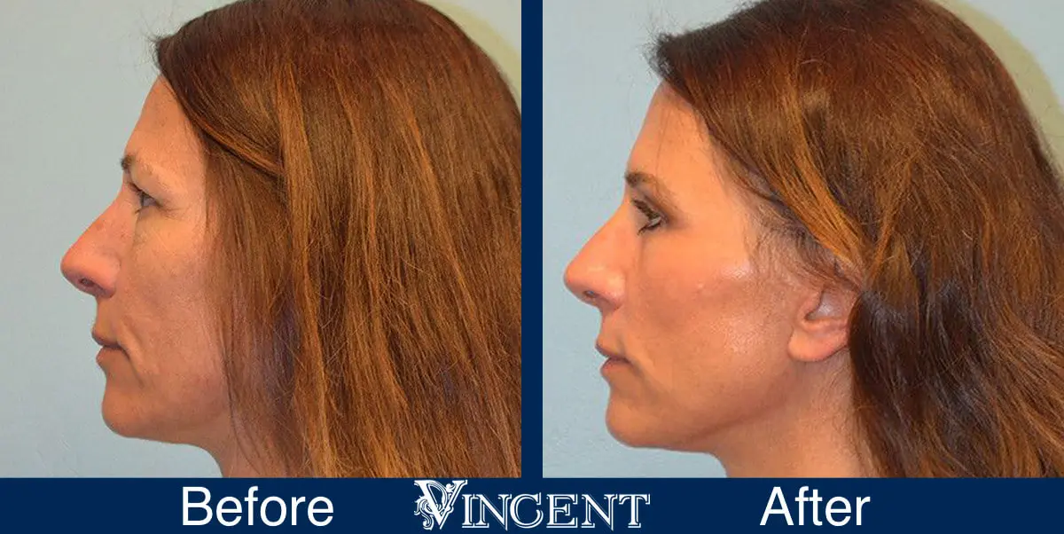 Blepharoplasty-before-and-after-utah-2602-Left