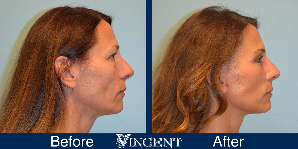 Blepharoplasty-before-and-after-utah-2602-Right