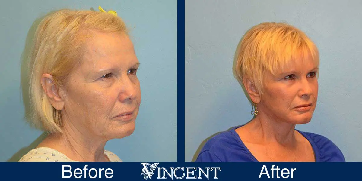 Blepharoplasty-before-and-after-utah-2603-Front-right