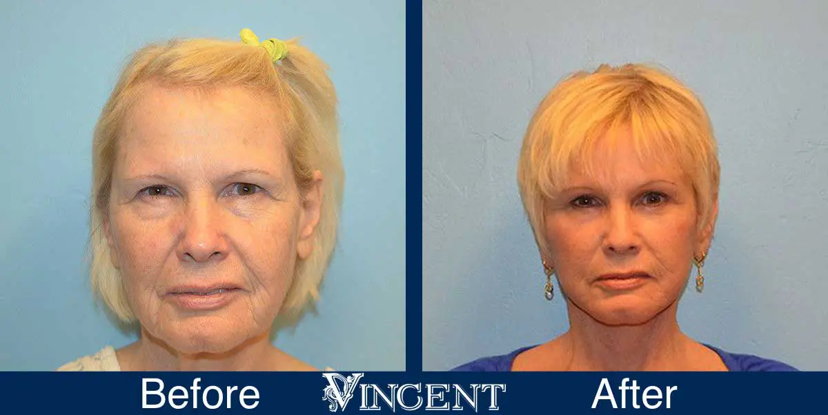 Blepharoplasty-before-and-after-utah-2603-Front