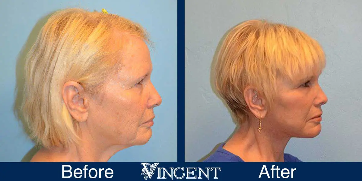 Blepharoplasty-before-and-after-utah-2603-right