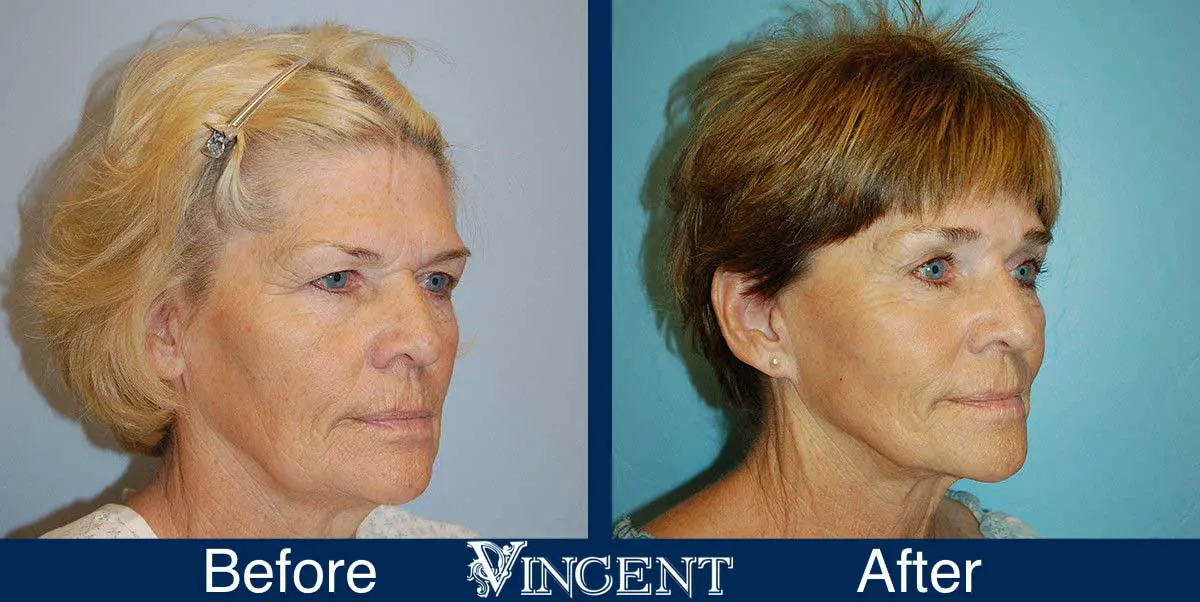 Blepharoplasty-before-and-after-utah-2604-front-right