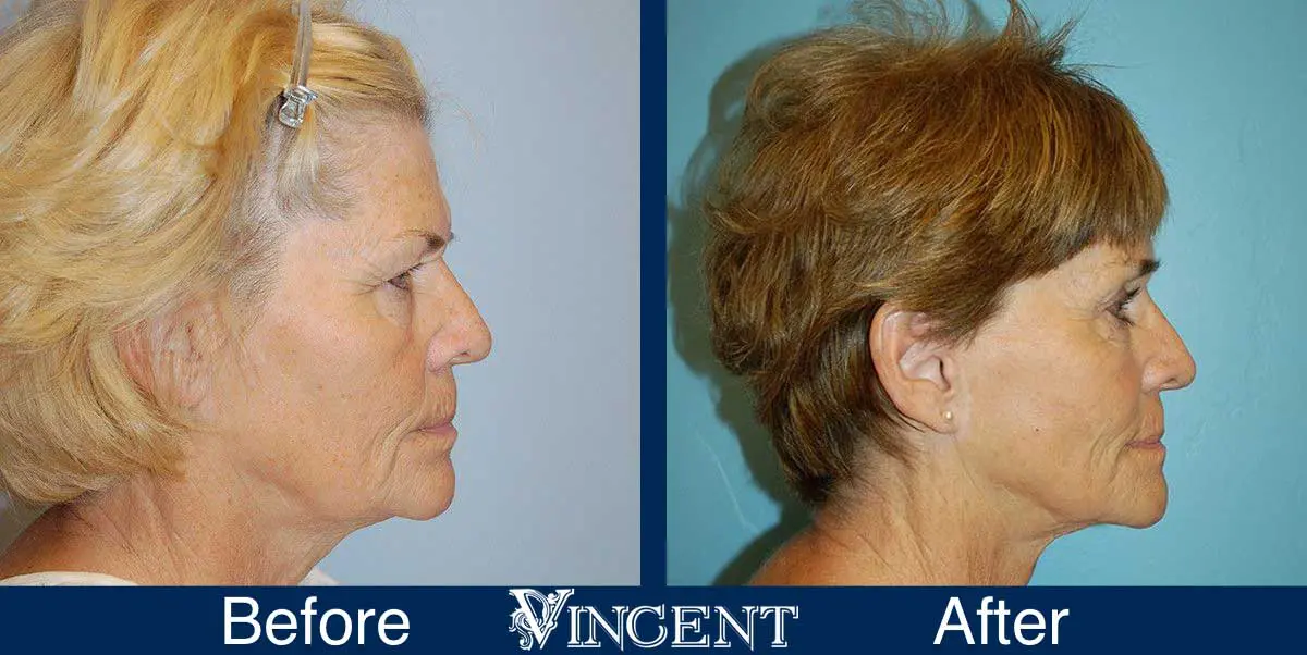 Blepharoplasty-before-and-after-utah-2604-right