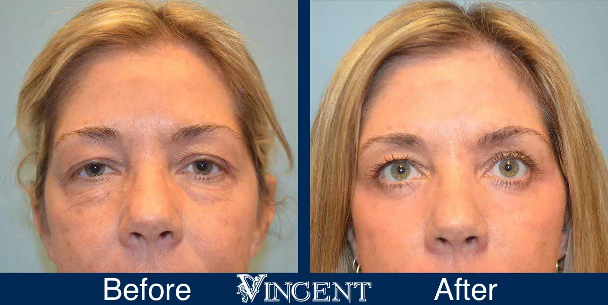Blepharoplasty-before-and-after-utah-2605_Co2_front