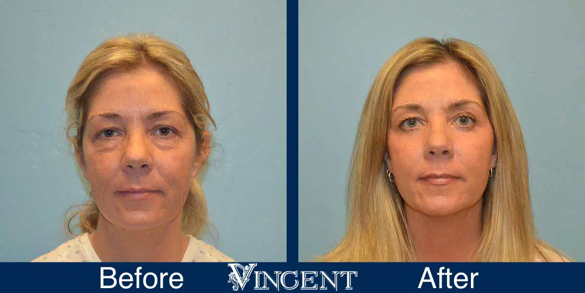 Blepharoplasty-before-and-after-utah-2605_Co2_full_face