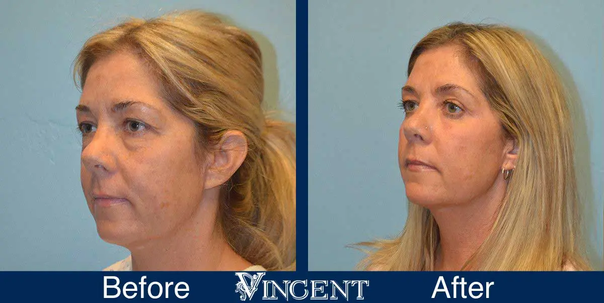 Blepharoplasty-before-and-after-utah-2605_Co2_leftside_2