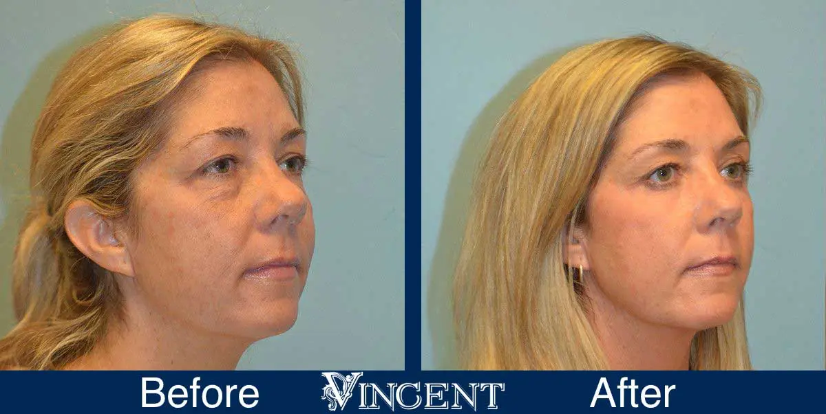 Blepharoplasty-before-and-after-utah-2605_Co2_rightside_2