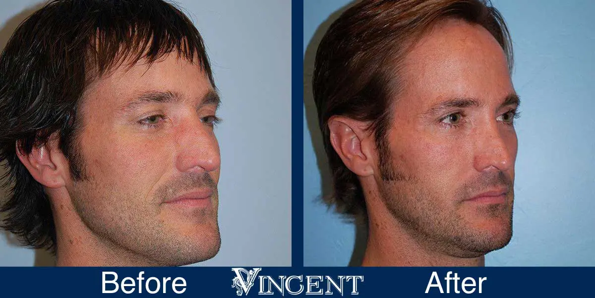 Blepharoplasty-before-and-after-utah-4503-front-right