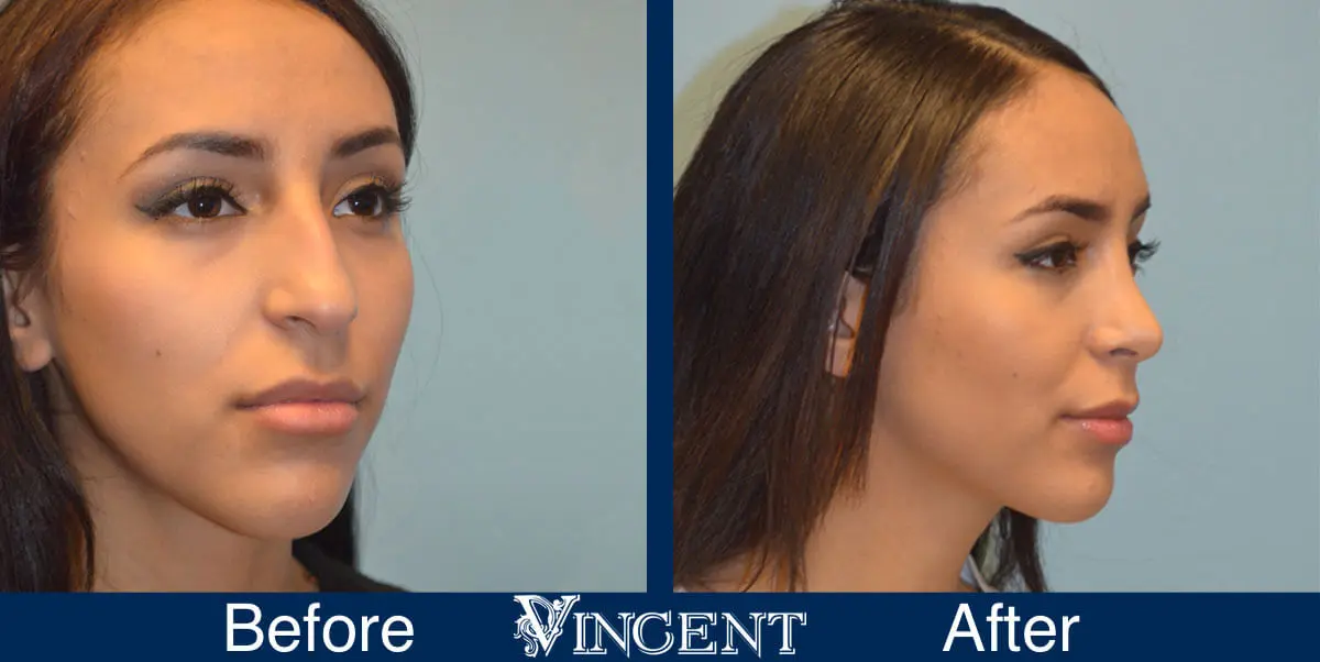 Facial-Surgery-Rhinoplasty-before-and-After-4504-3