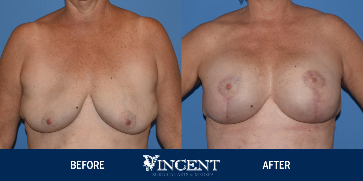 MRN-108414-Breasts-with-Anchor-Lift