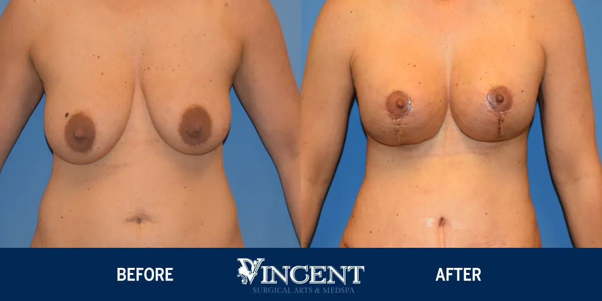 MRN-2923-Breast-Aug-Anchor-Lift_result