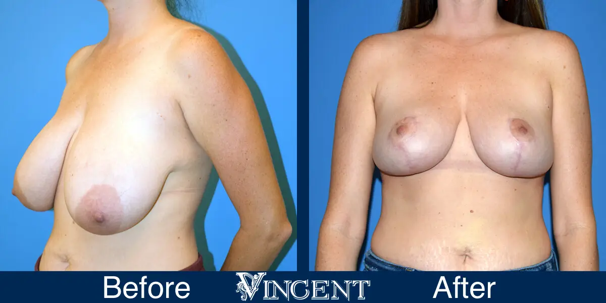 anchor-lift-no-implant-2