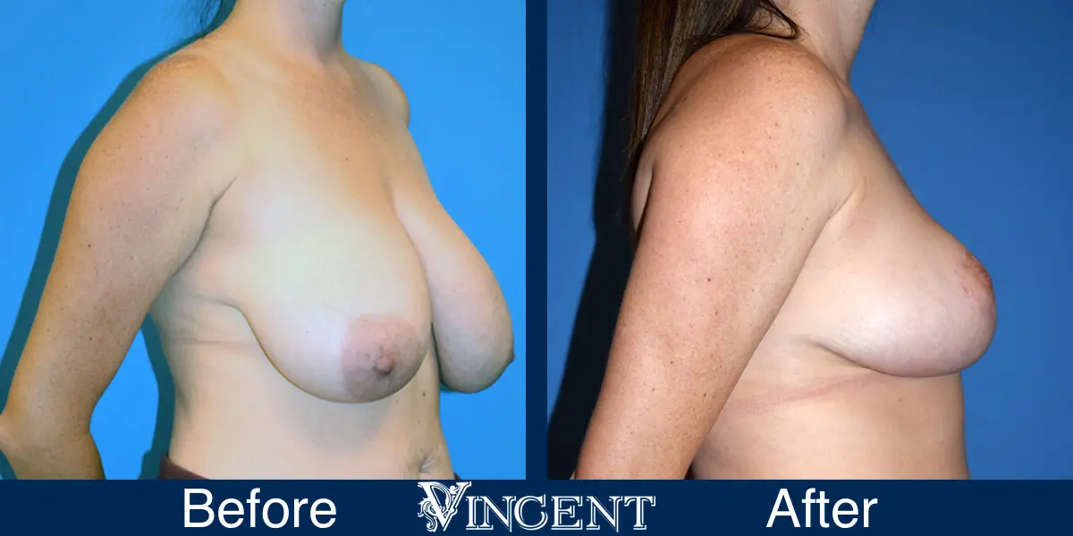 anchor-lift-no-implant-3