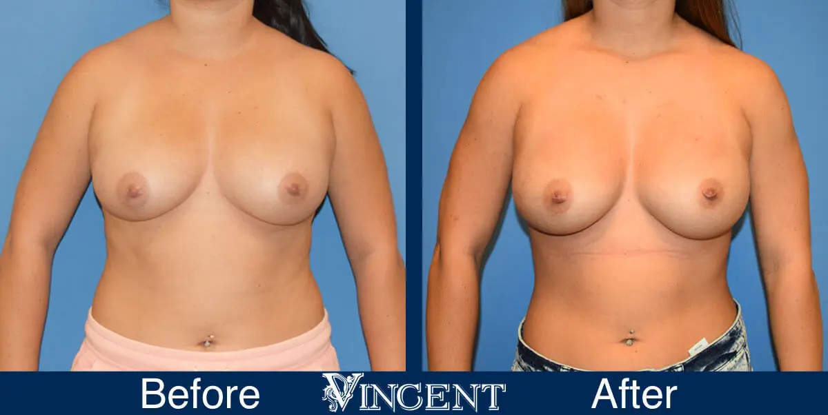breast-augmentation-before-and-after-salt-lake-city-utah-vincent-surgical-arts-1652-front