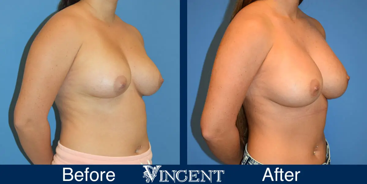 breast-augmentation-before-and-after-salt-lake-city-utah-vincent-surgical-arts-1652-right
