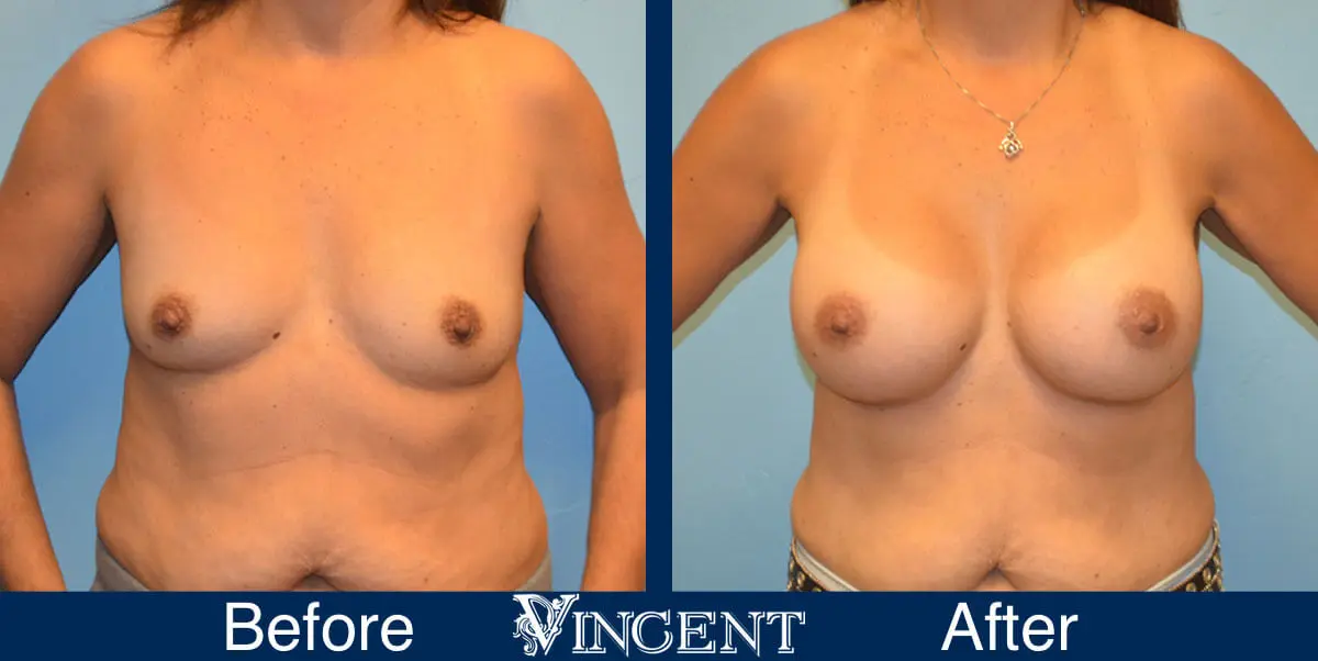 breast-augmentation-before-and-after-salt-lake-city-utah-vincent-surgical-arts-2171-front
