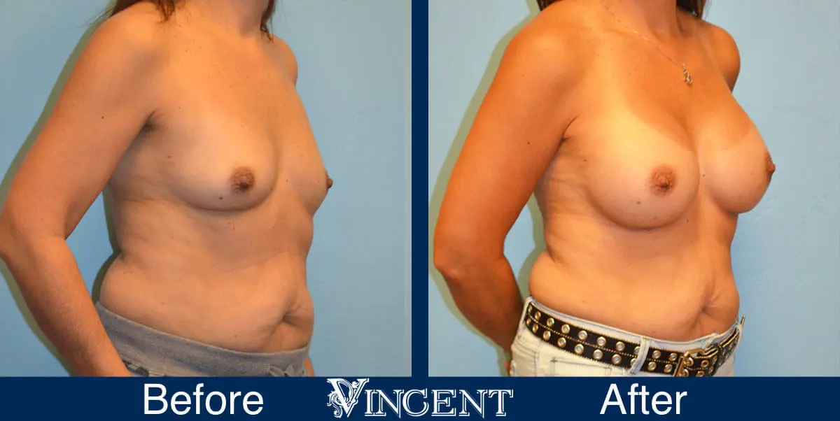 breast-augmentation-before-and-after-salt-lake-city-utah-vincent-surgical-arts-2171-right