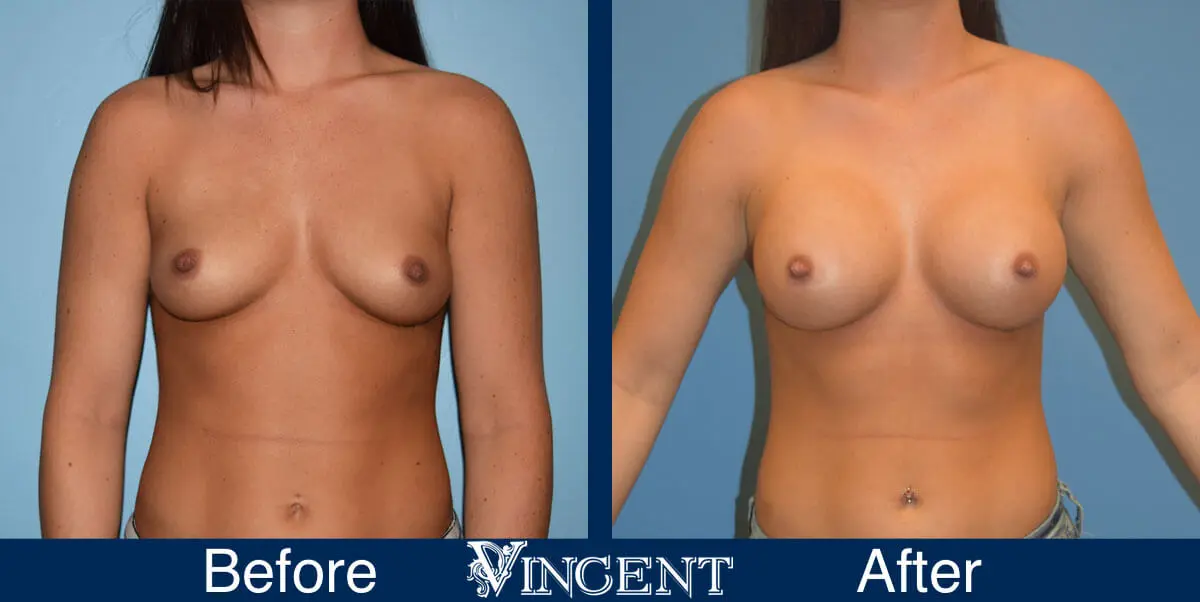 breast-augmentation-before-and-after-salt-lake-city-utah-vincent-surgical-arts-3169-front