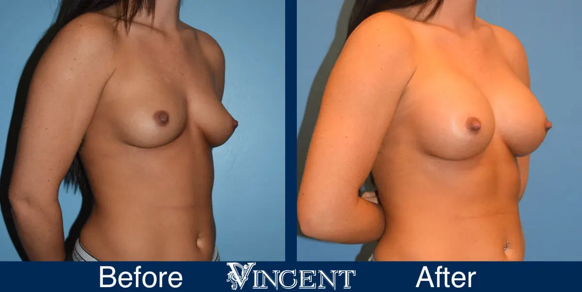 breast-augmentation-before-and-after-salt-lake-city-utah-vincent-surgical-arts-3169-right