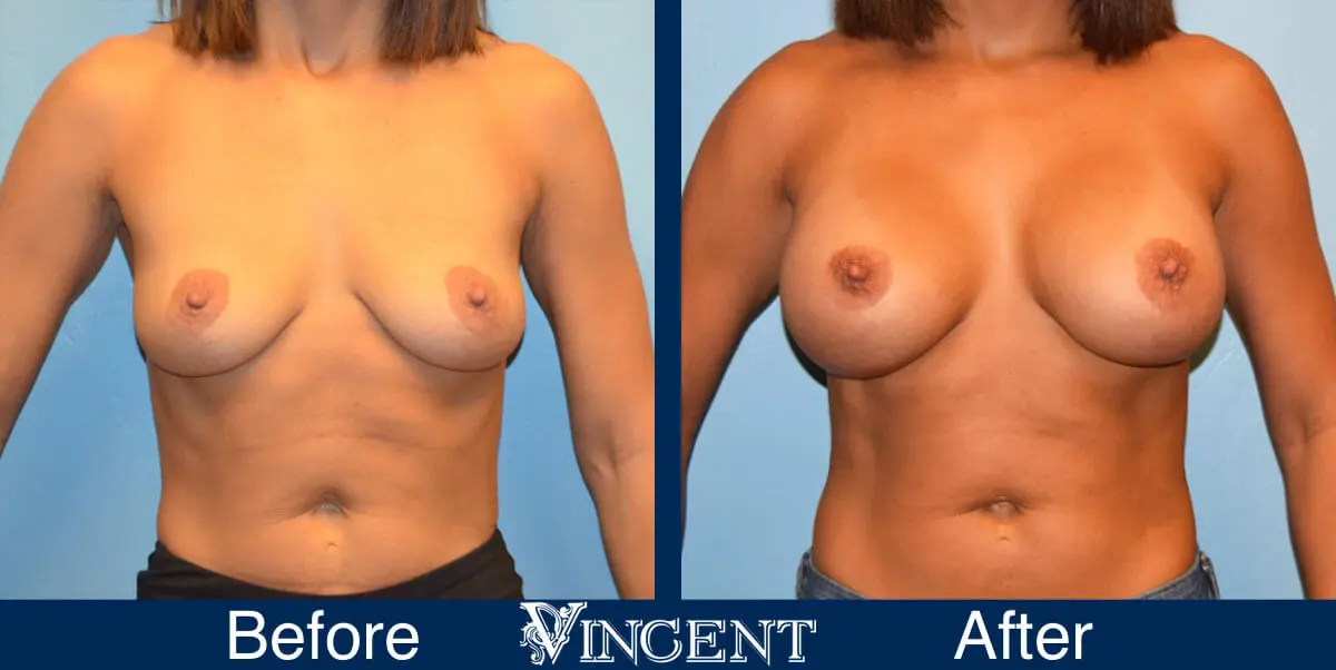 breast-augmentation-before-and-after-salt-lake-city-utah-vincent-surgical-arts-7375-front