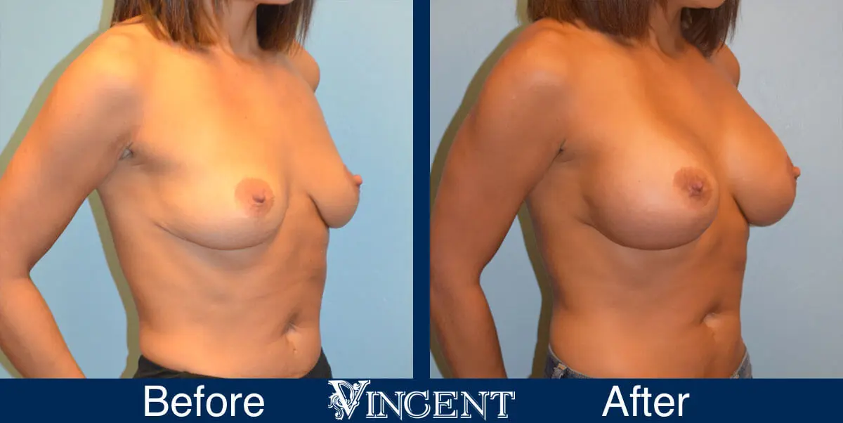 breast-augmentation-before-and-after-salt-lake-city-utah-vincent-surgical-arts-7375-right