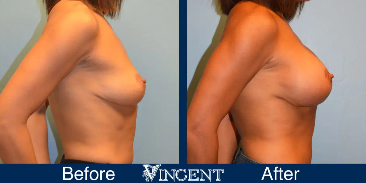 breast-augmentation-before-and-after-salt-lake-city-utah-vincent-surgical-arts-7375-side