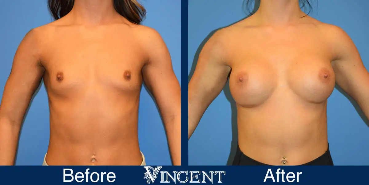 breast-augmentation-before-and-after-salt-lake-city-utah-vincent-surgical-arts-914846-front