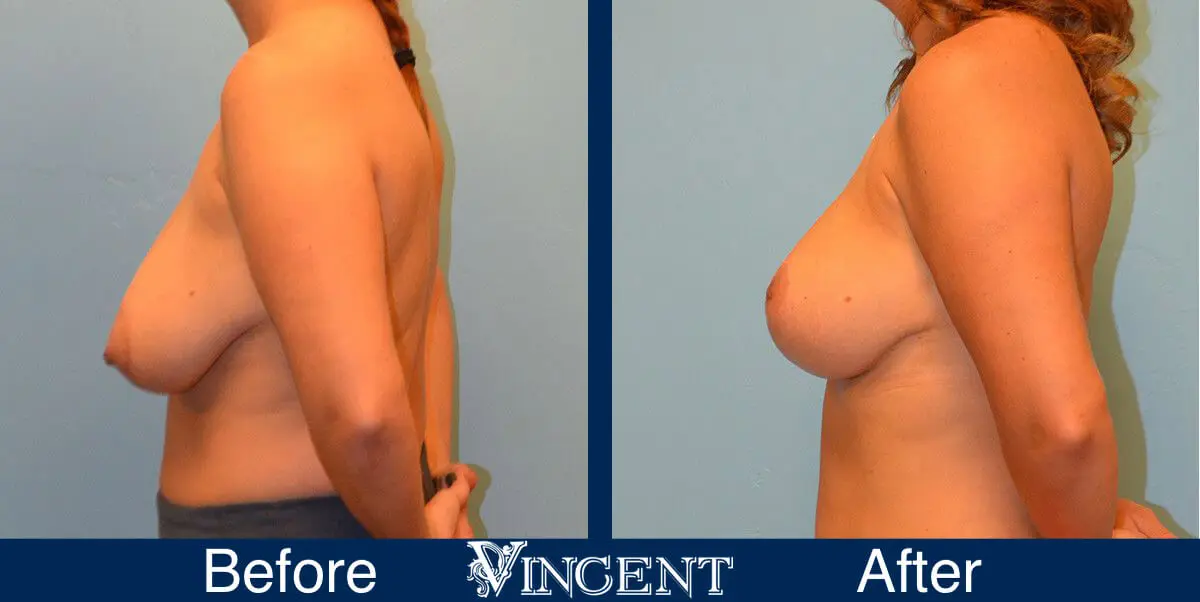 breast-lift-before-and-after-utah-8001-Full-Left
