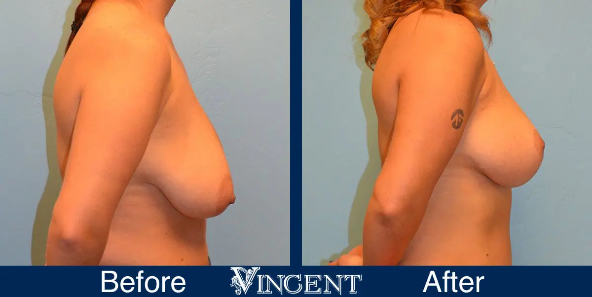 breast-lift-before-and-after-utah-8001-Full-Right