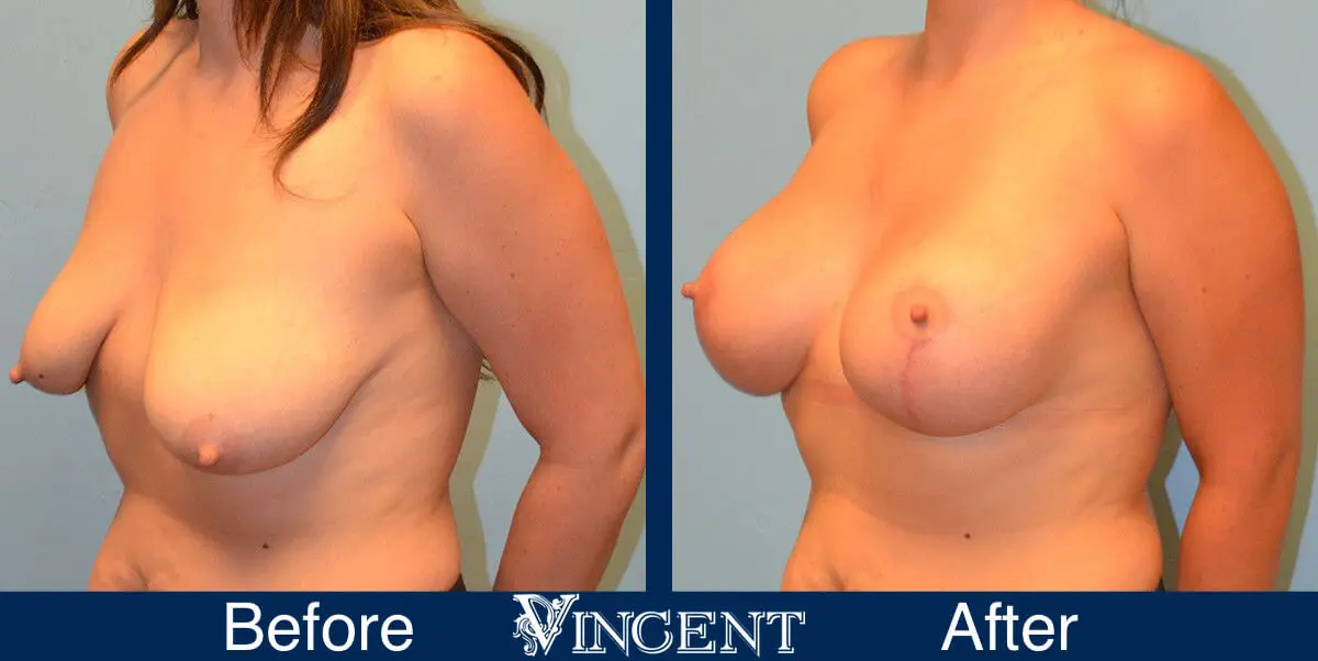 breast-lift-before-and-after-utah-8002-Left-front