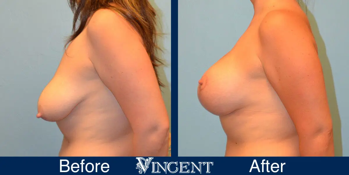breast-lift-before-and-after-utah-8002-Left