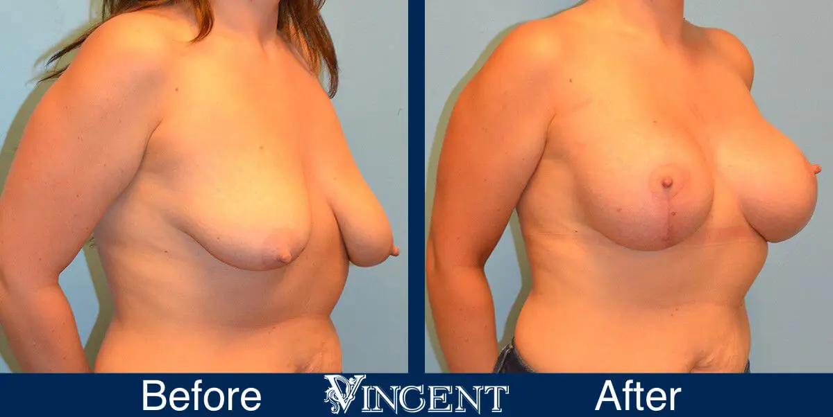 breast-lift-before-and-after-utah-8002-Right-Front