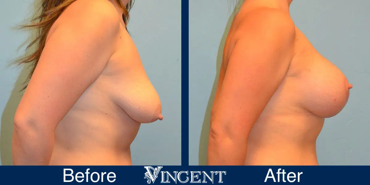 breast-lift-before-and-after-utah-8002-Right
