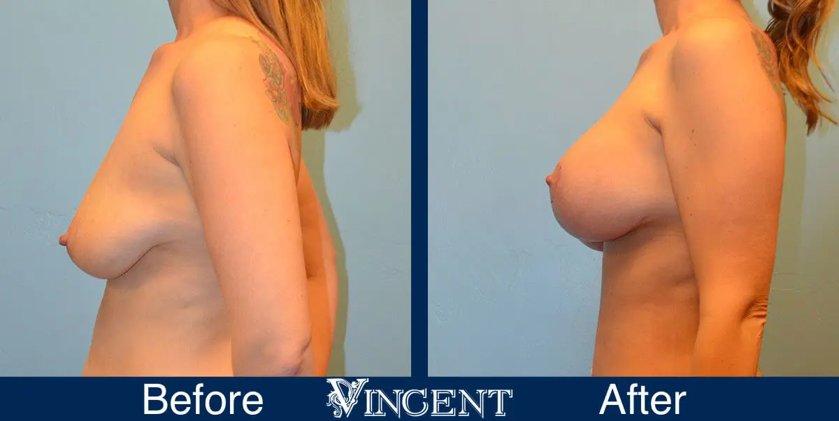 breast-lift-before-and-after-utah-8003-Full-Left