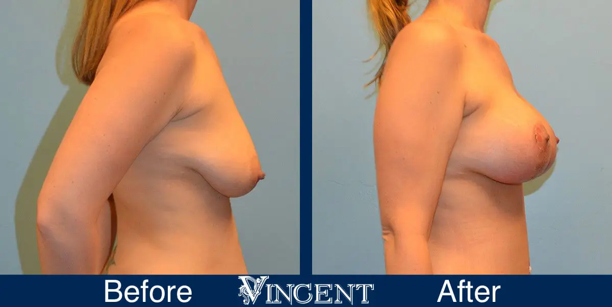 breast-lift-before-and-after-utah-8003-Full-Right
