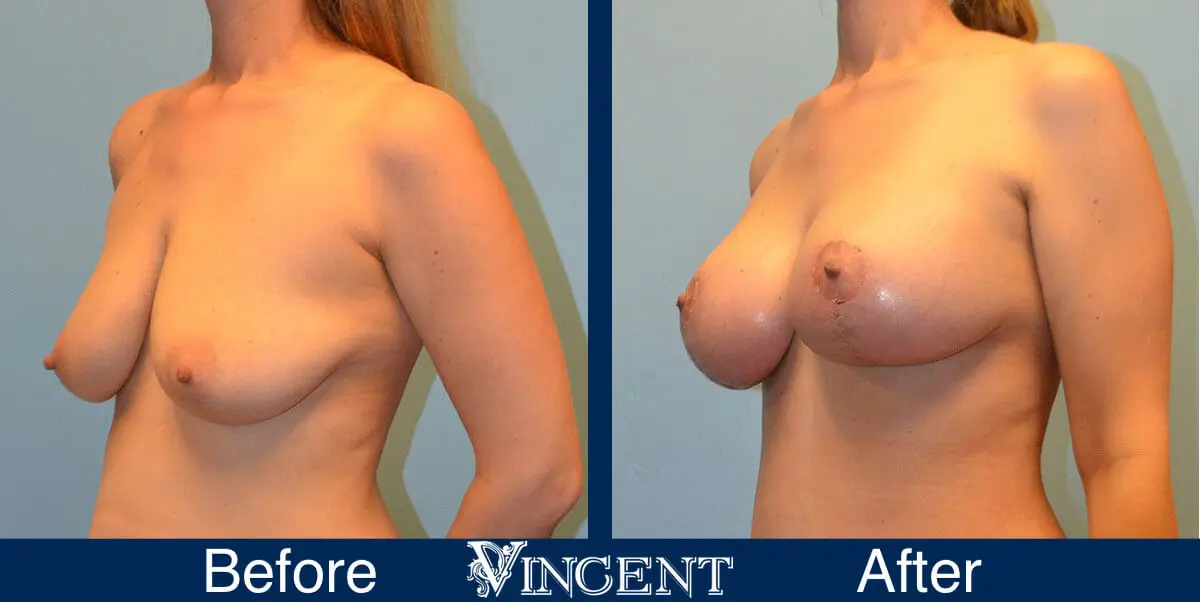 breast-lift-before-and-after-utah-8003-Left