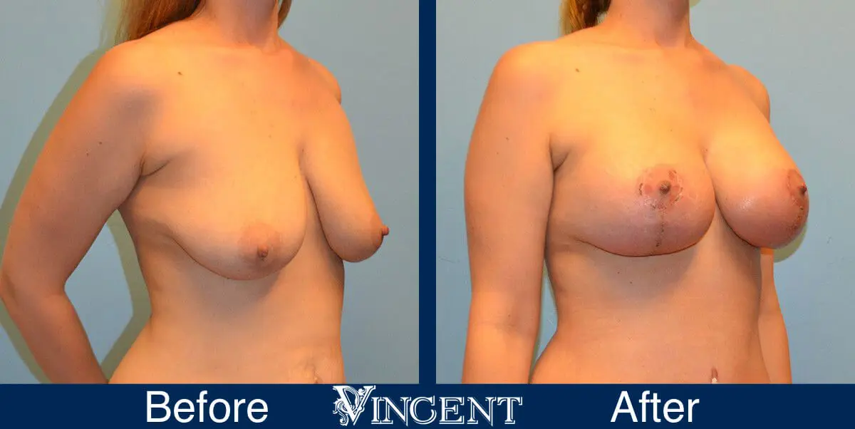 breast-lift-before-and-after-utah-8003-Right