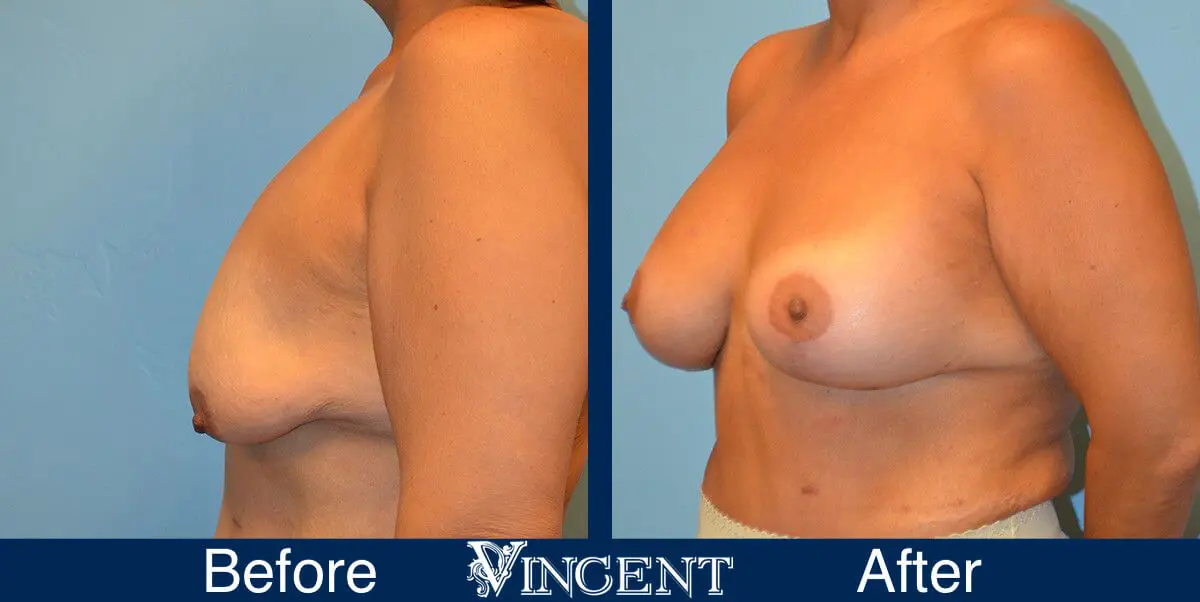 breast-lift-before-and-after-utah-8004-Full-Left