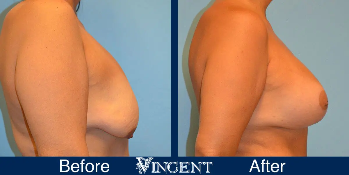 breast-lift-before-and-after-utah-8004-Full-Right
