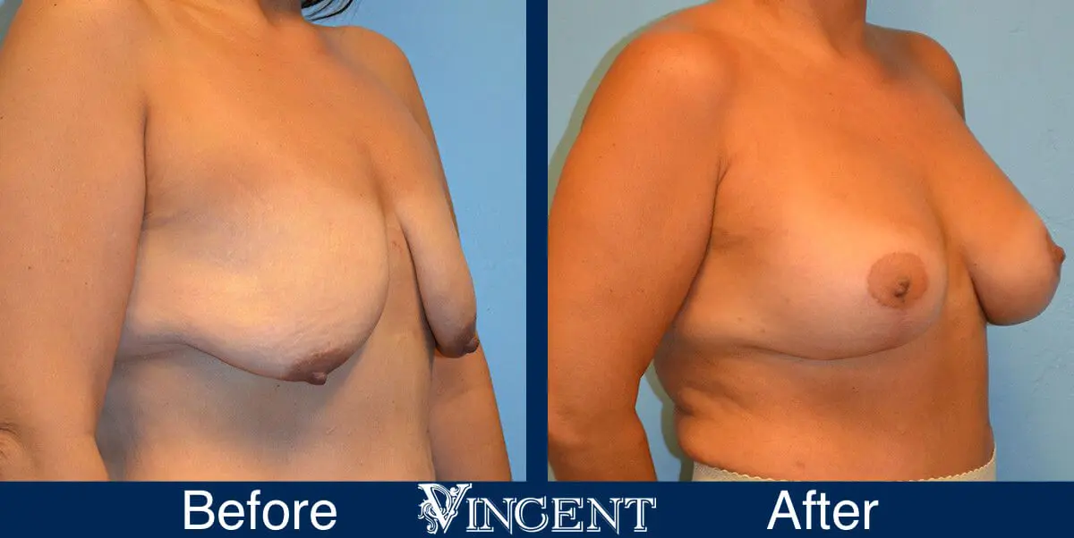 breast-lift-before-and-after-utah-8004-Right
