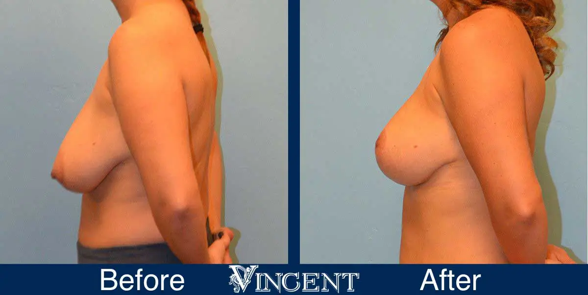 breast-reduction-before-and-after-utah-vincent-surgical-arts-Full-Left-8001
