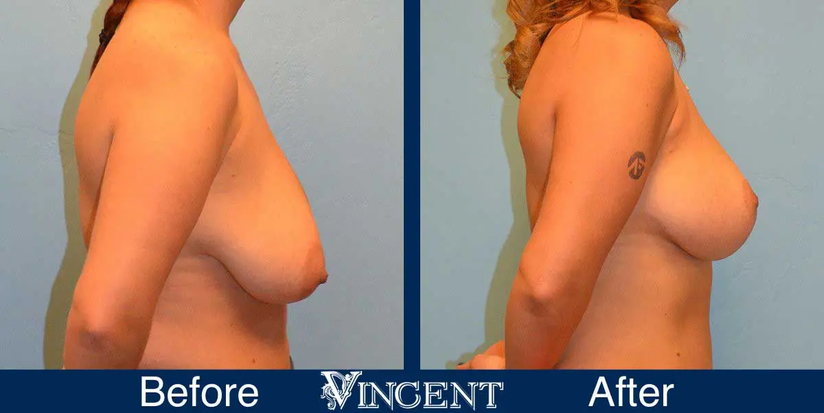 breast-reduction-before-and-after-utah-vincent-surgical-arts-Full-Right-8001