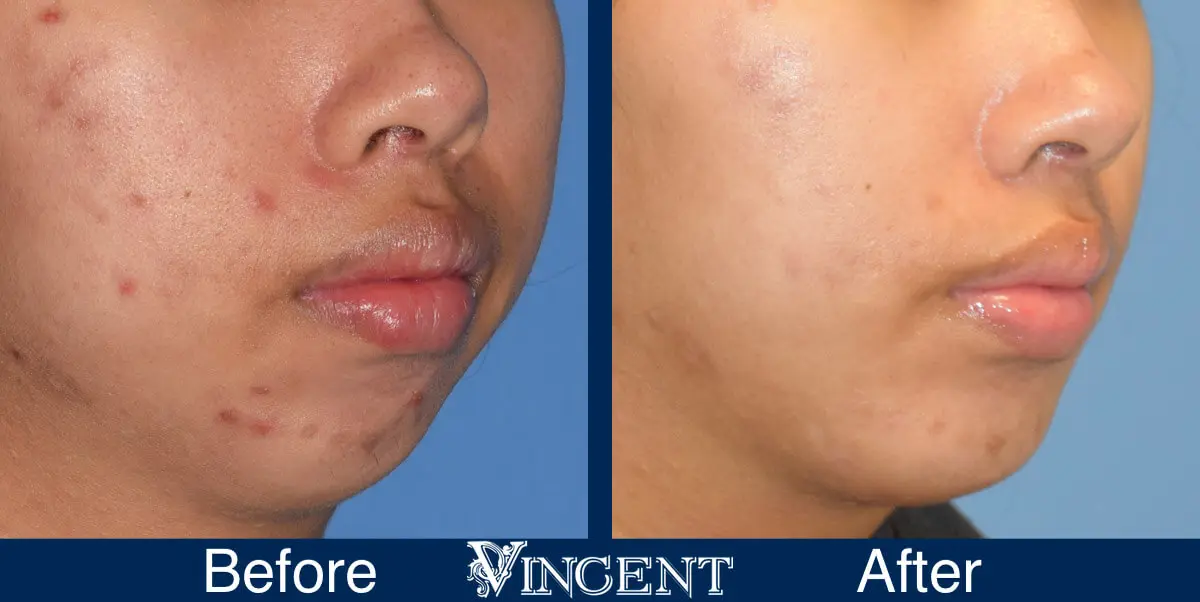 chin-implant-before-and-after-female-utah-right