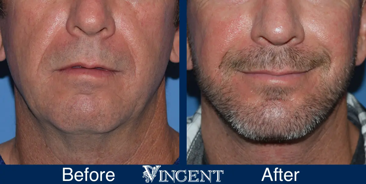 chin-implant-before-and-after-male-utah-front