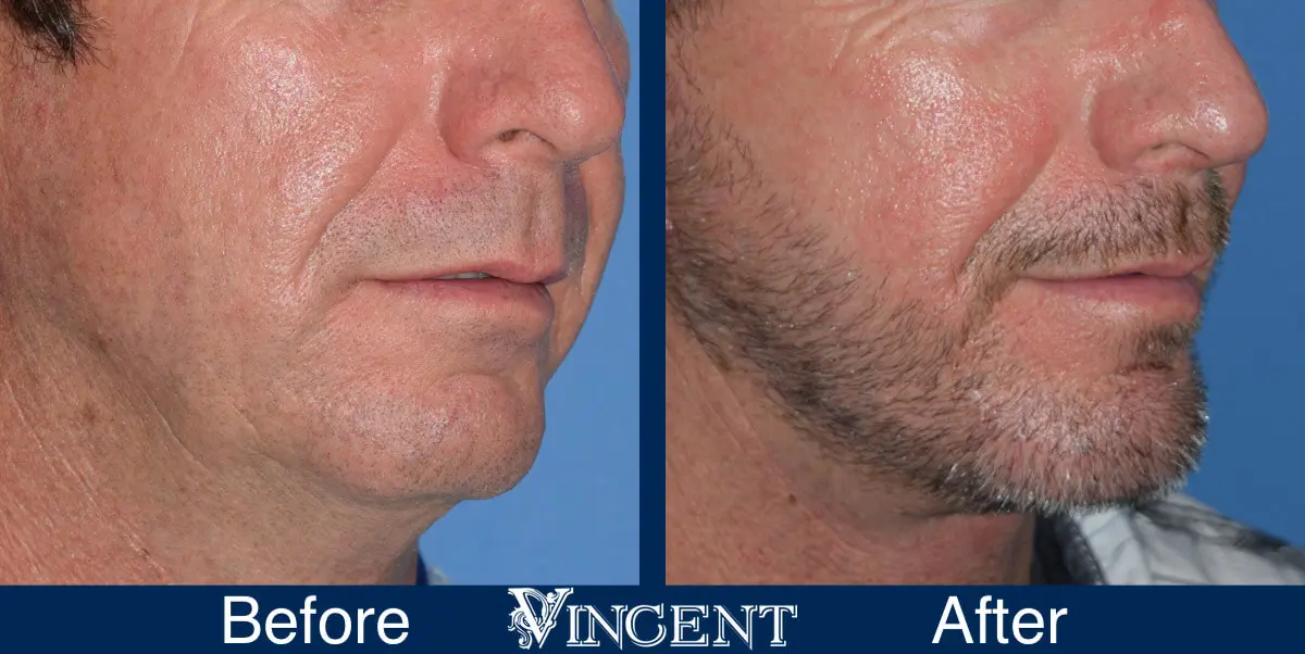 chin-implant-before-and-after-male-utah-right