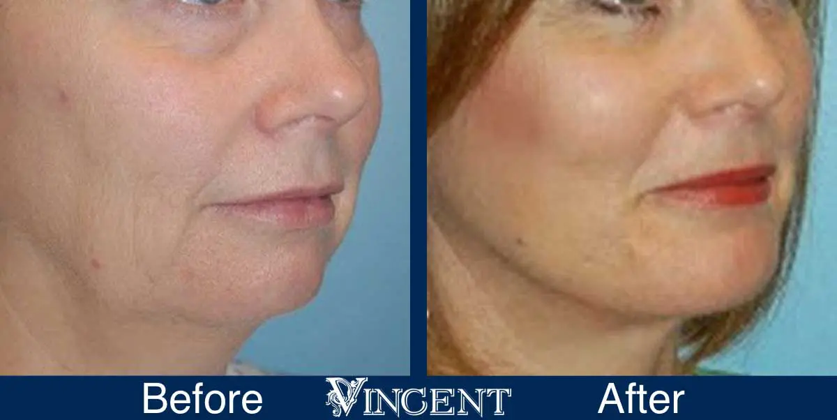 chin-implant-before-and-after-utah-0902_left1